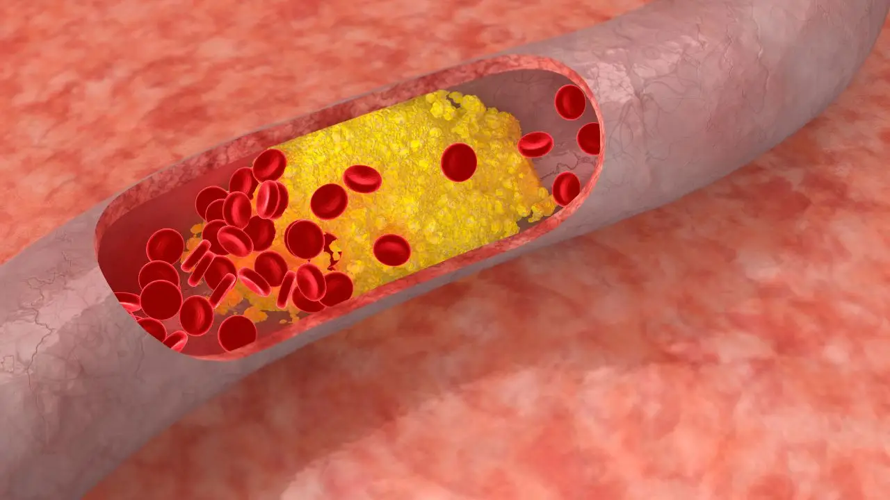 Colesterolo alto: i segnali che spesso trascuriamo secondo il cardiologo Colesterolo alto: i segnali che spesso trascuriamo secondo il cardiologo