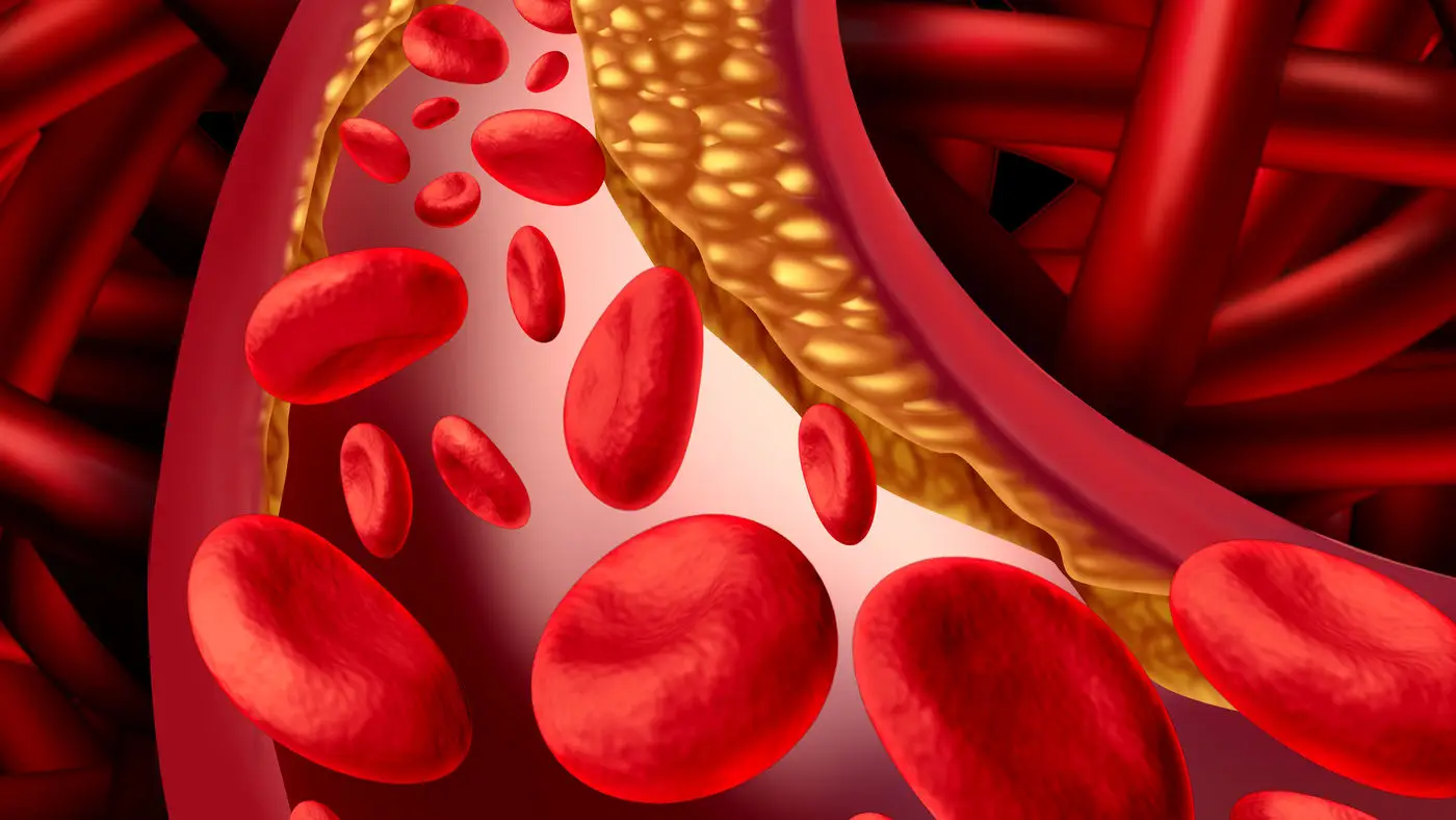 Colesterolo alto: i segnali che spesso trascuriamo secondo il cardiologo Colesterolo alto: i segnali che spesso trascuriamo secondo il cardiologo